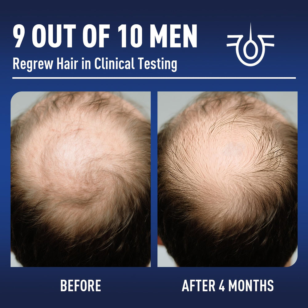 Wuwenbin biotin-infused minoxidil formula bottle close-up for everyday use