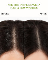 X20Hair psoriasis shampoo botanicals close-up highlighting calming, antioxidant-rich scalp care