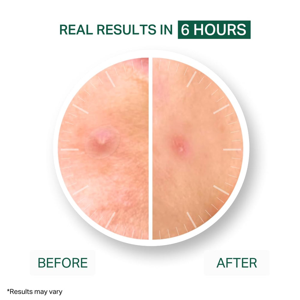 Y'OUR patches drawing out impurities to help blemishes appear calmer by morning.