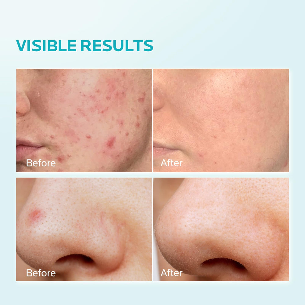 ZealSea azelaic acid cream packaging front, premium care solution.