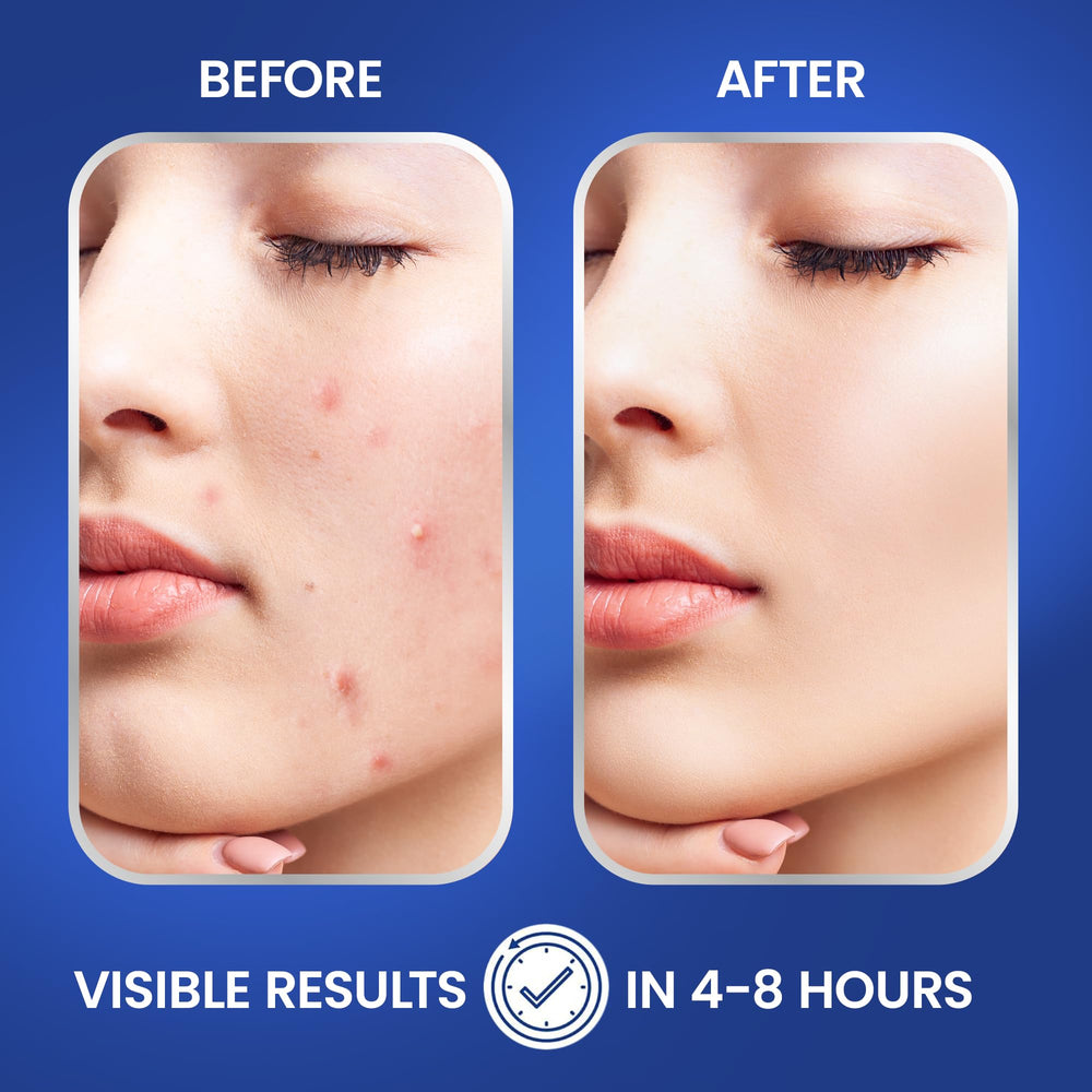 72-pack provides ongoing supply for blemish care.
