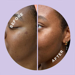 ZitSticka Hyperfade dissolving-darts show deep actives delivery in skin.