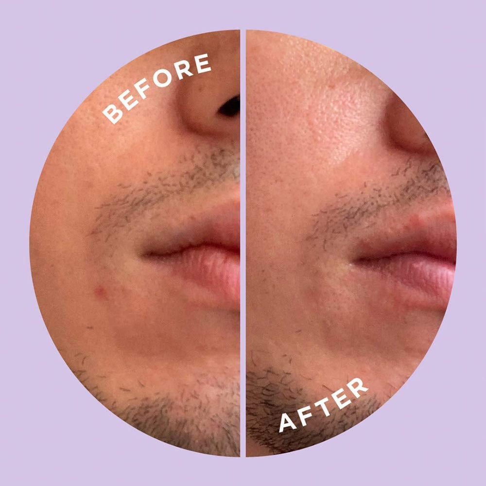 ZitSticka Hyperfade vitamin-c and kojic-acid support brightening.
