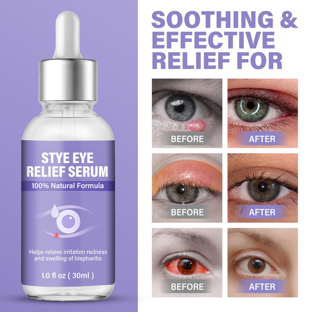 Packaging box of ZVBZVB Stye Eye Treatment with 30 ml bottle. 