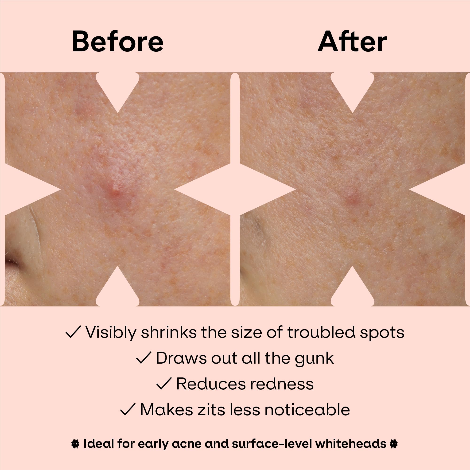 ZVYK pimple patches cute-patterns display versatile wear for daily activities