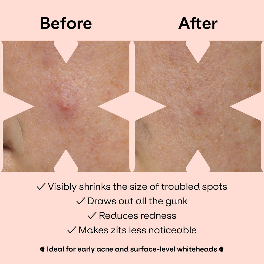 ZVYK pimple patches cute-patterns display versatile wear for daily activities